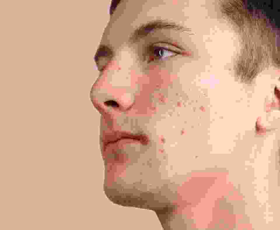 Before view of a man’s cheek in the skin comparison