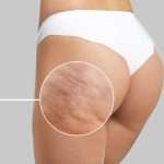 Cellulite and Skin Texture: What to Know Before a Consultation
