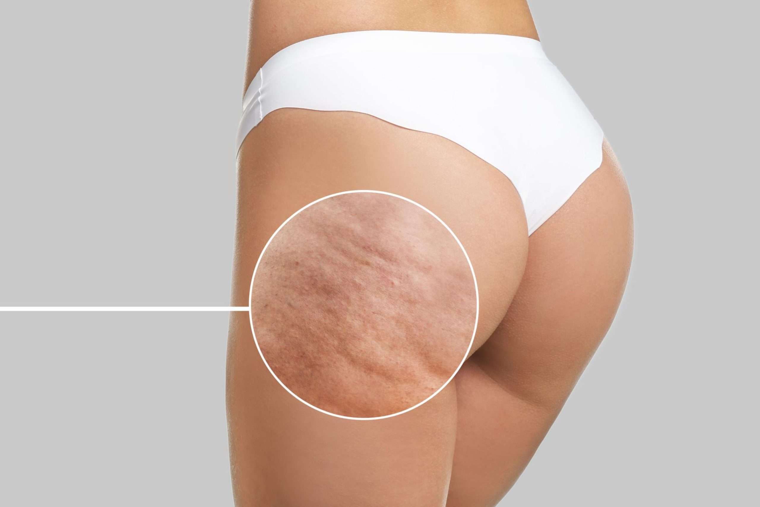 Close-up of a woman’s hip and thigh with an inset showing dimpled skin texture