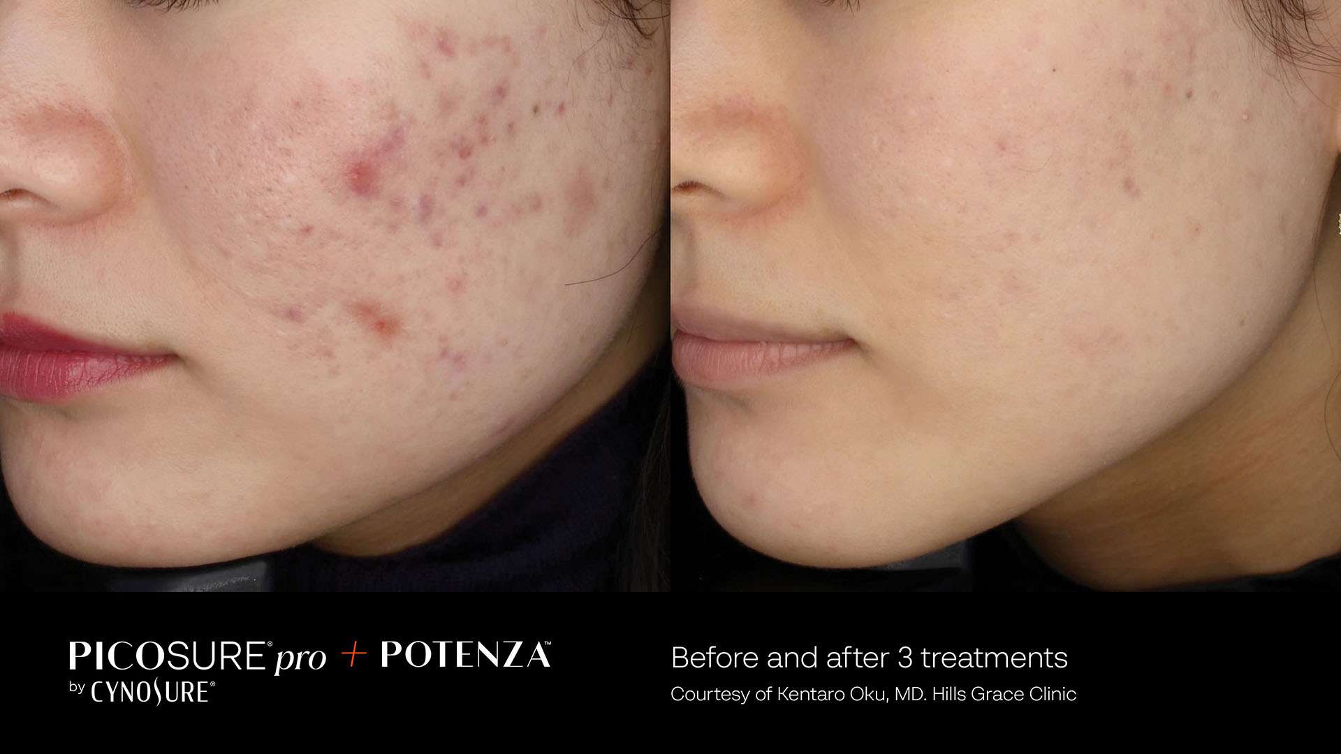 Side-by-side cheek skin comparison showing red spots and uneven texture