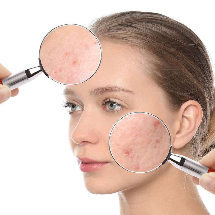 Acne scar treatment services