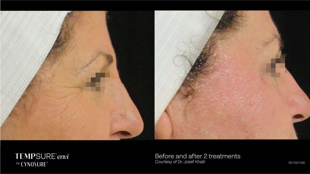 TempSure Envi vendor comparison of skin around the eye, courtesy of Dr. Josef Khalil