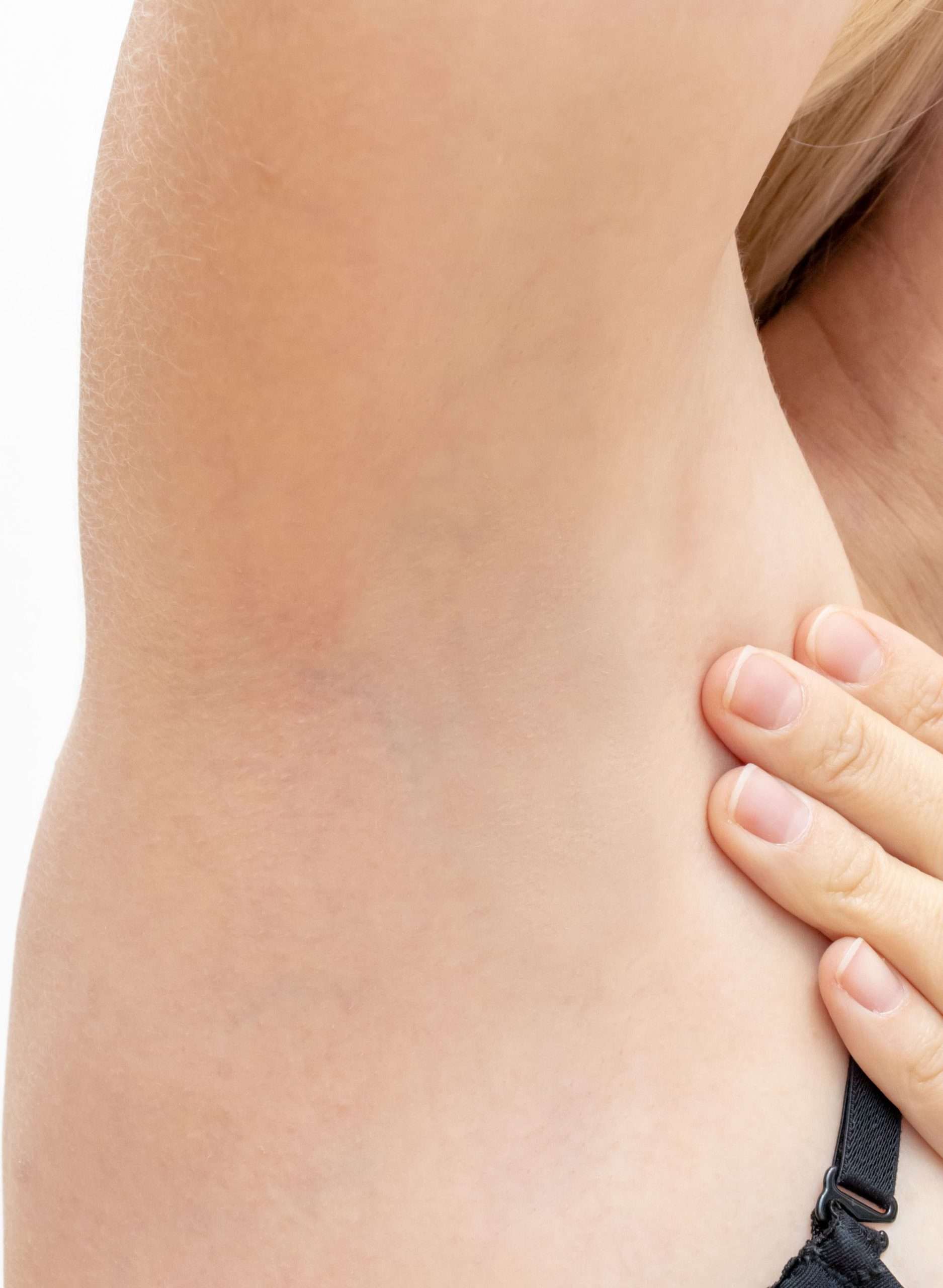 Close-up of the hair-free underarm shown in the after image