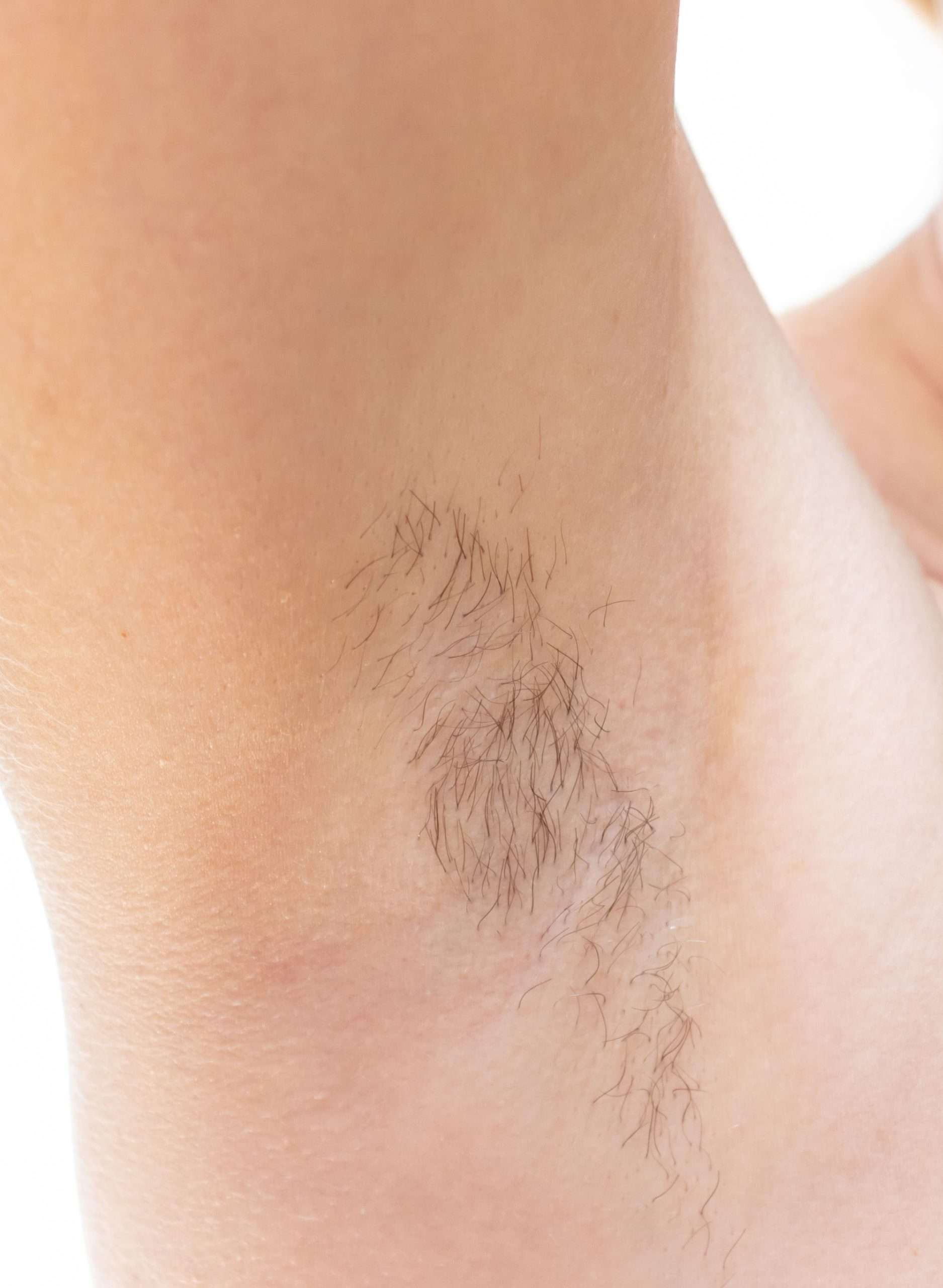 Close-up of an underarm with visible hair in the before image