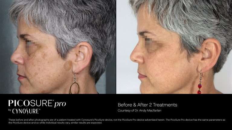 PicoSure before-and-after side views of a woman’s face