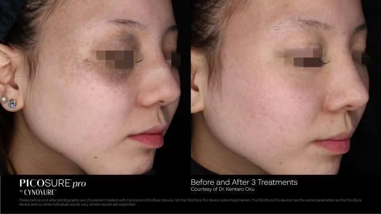 PicoSure before-and-after comparison of the temple and cheek