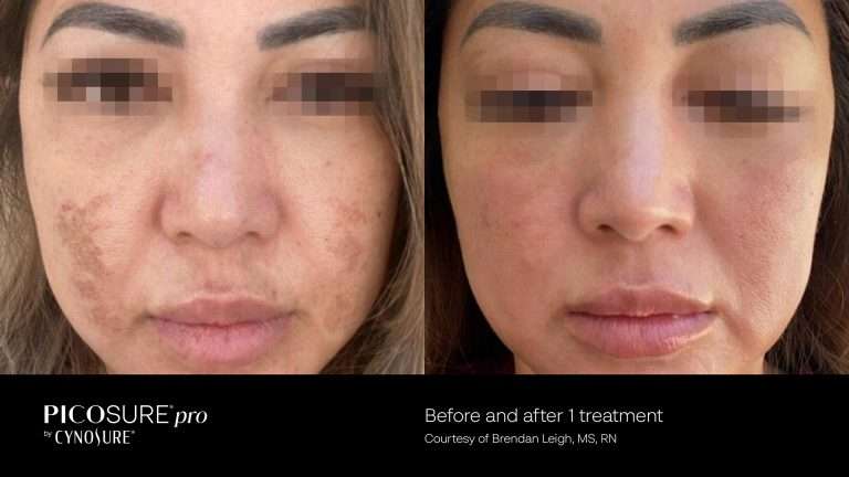 PicoSure Pro before-and-after front views of a woman’s face