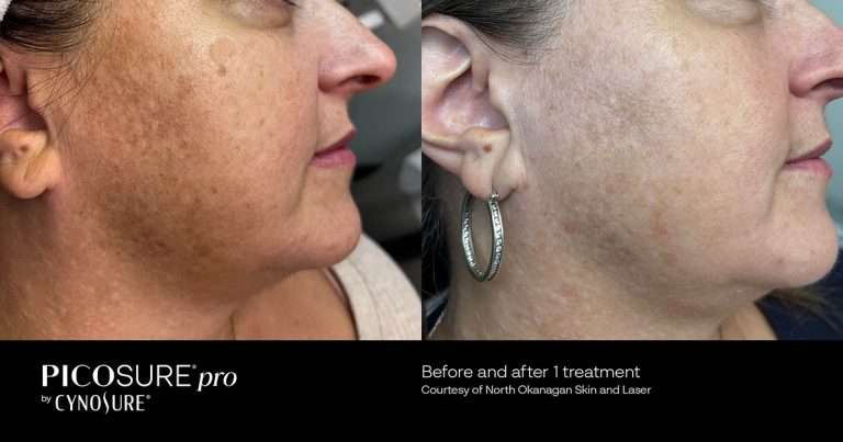 PicoSure Pro before-and-after profile views of a cheek and jawline