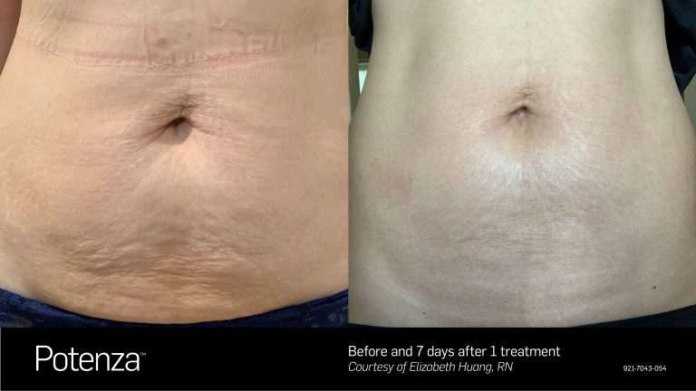 Potenza before-and-after comparison of the abdomen