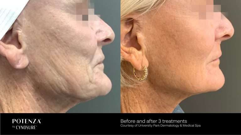 Potenza before-and-after profile views of a woman’s cheek, jawline and neck