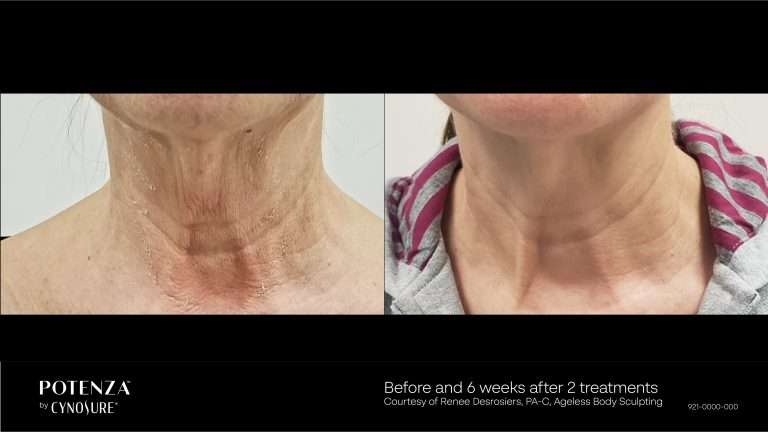 Potenza before-and-after front views of the neck