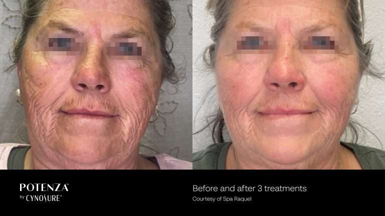 Potenza before-and-after front views of a woman’s face with grey hair