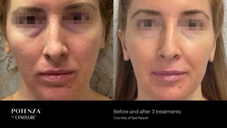 Potenza before-and-after close-up front views of the cheeks and mouth