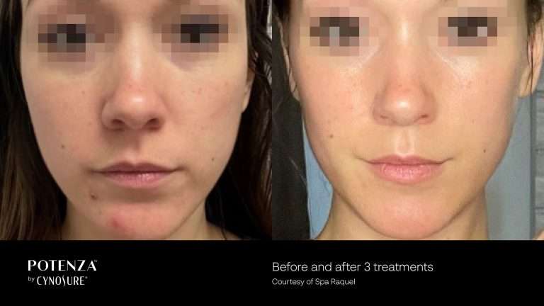 Potenza before-and-after front views of a woman’s face with brown hair