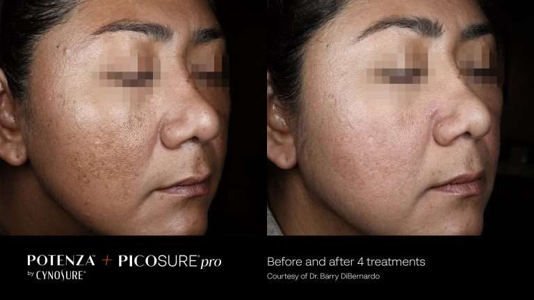 Potenza and PicoSure Pro before-and-after side views of a cheek