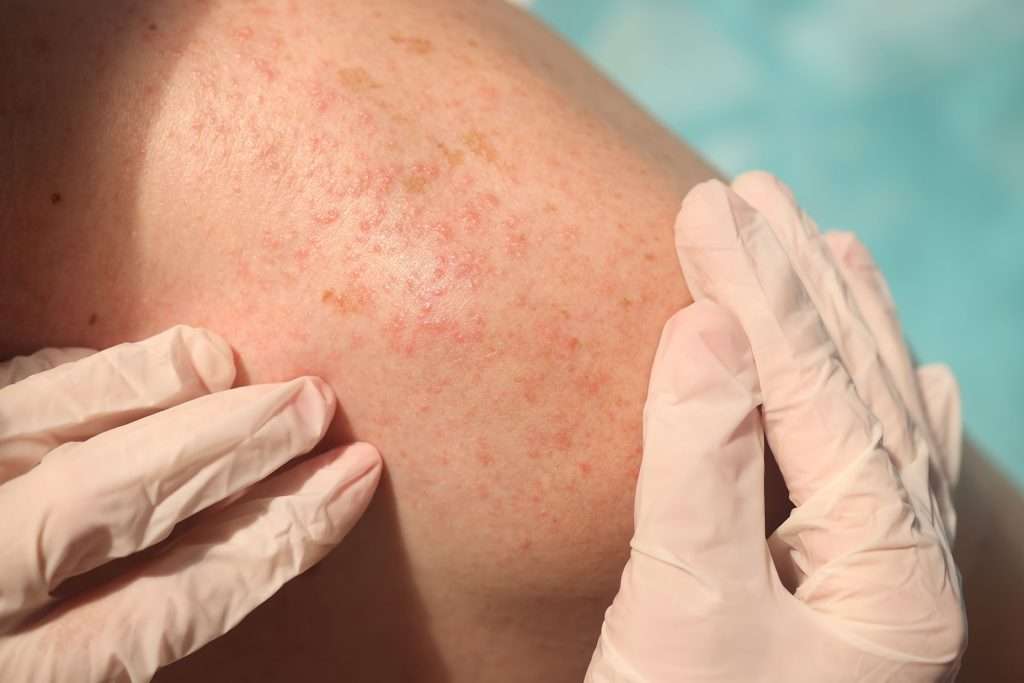 Gloved hands examining an area of skin with redness and spots