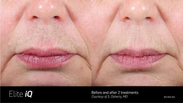 Elite iQ before-and-after comparison of skin around a woman’s mouth