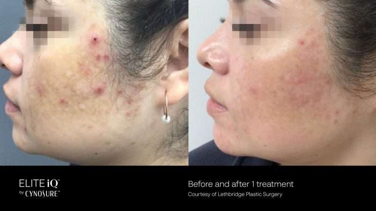 Elite iQ before-and-after side views of a cheek and jawline