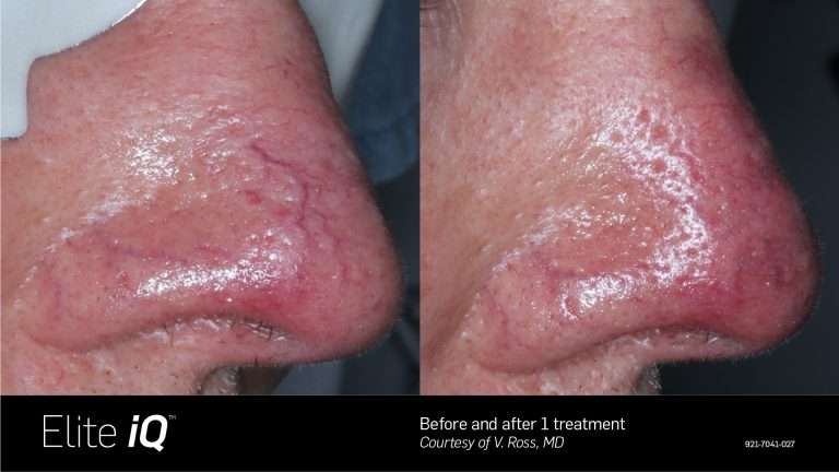 Elite iQ before-and-after close-up comparison of a nose
