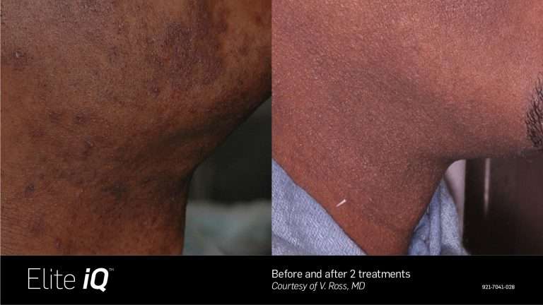 Elite iQ before-and-after comparison of the lower cheek and neck