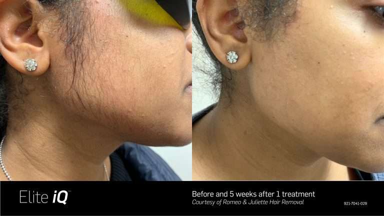Elite iQ before-and-after comparison of facial hair along the cheek and jawline