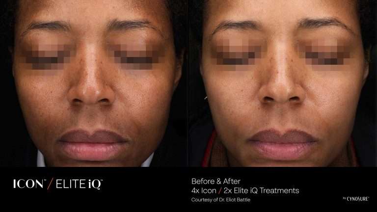 ICON and Elite iQ before-and-after front views of a face