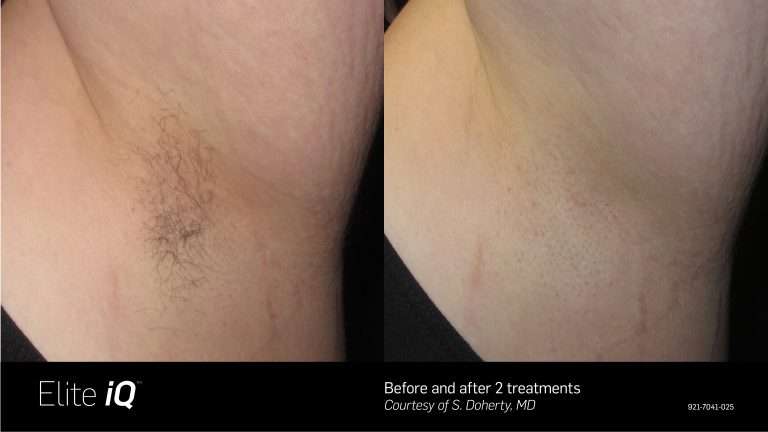 Elite iQ before-and-after comparison of hair under the chin