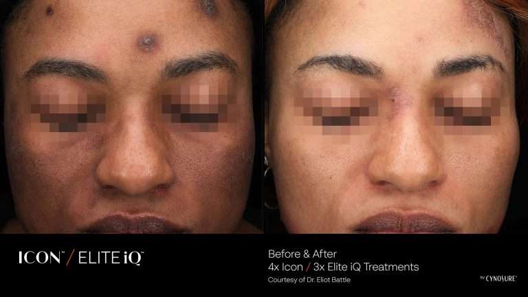 ICON and Elite iQ before-and-after close-up views of the forehead and cheeks
