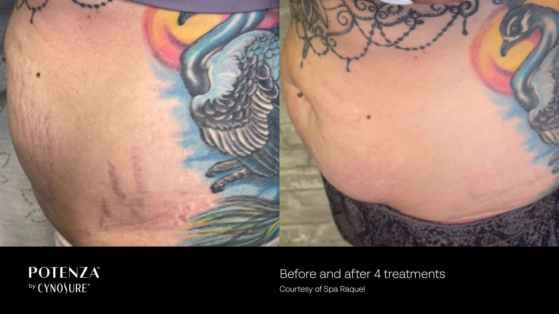Potenza vendor comparison of stretch marks beside a hip tattoo, courtesy of Spa Raquel