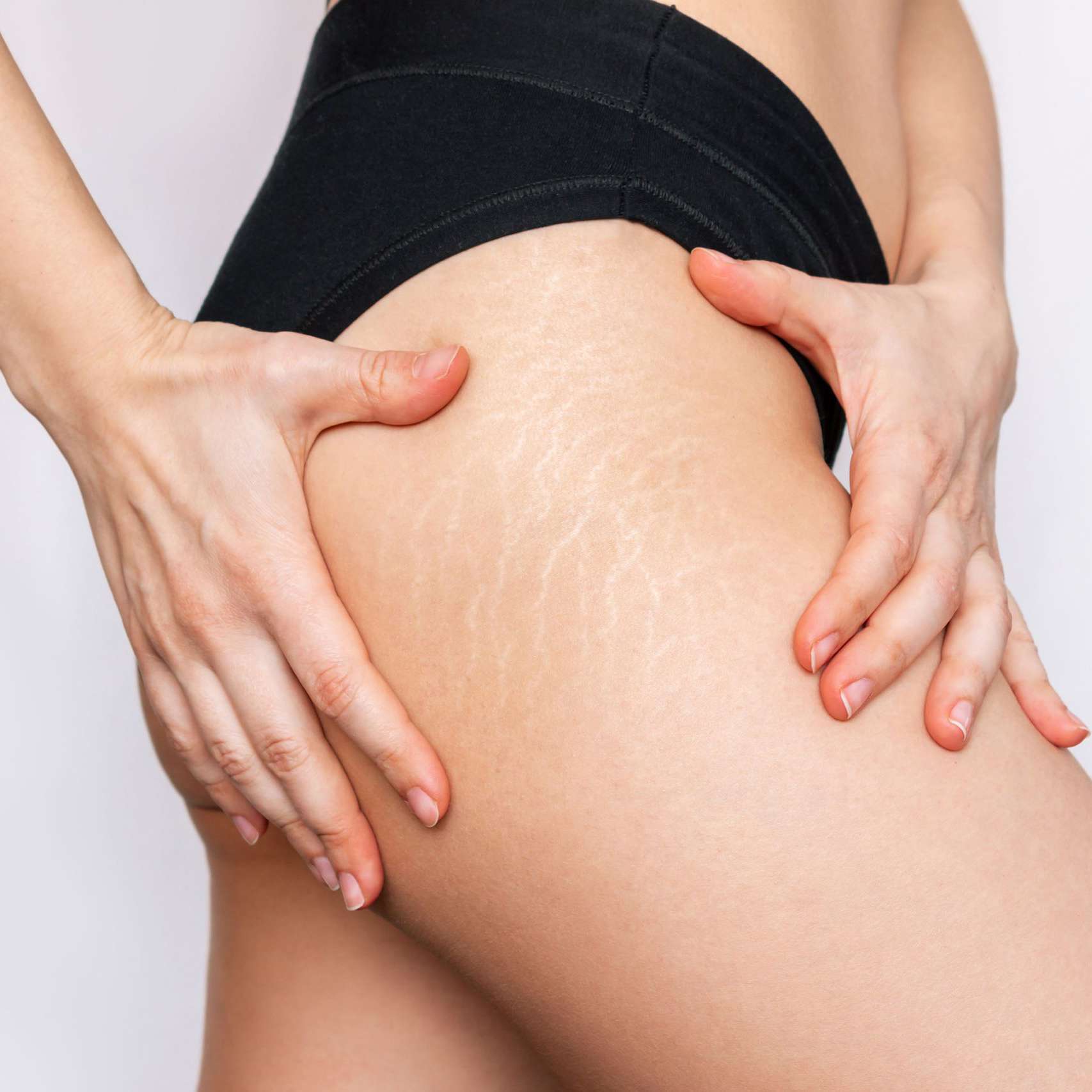 Stretch mark treatment services