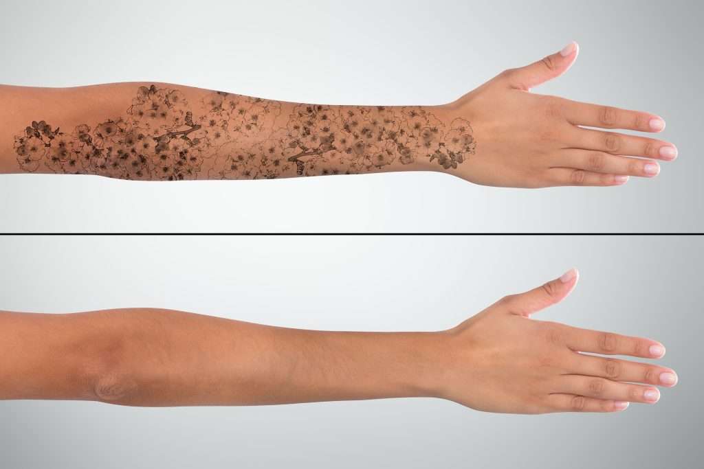 Two views of a forearm, with a floral tattoo above and bare skin below
