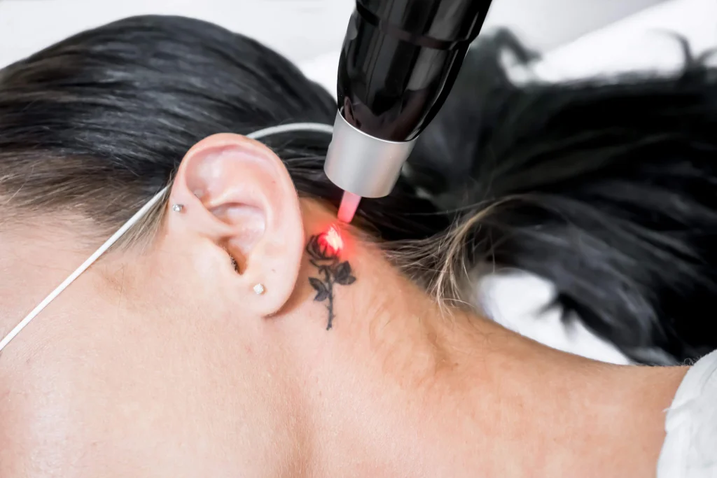 Laser handpiece directed at a rose tattoo behind the ear