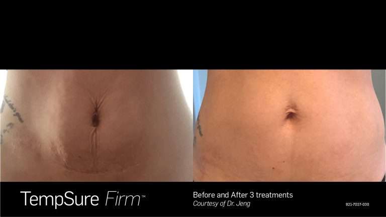 TempSure Firm before-and-after front views of the abdomen