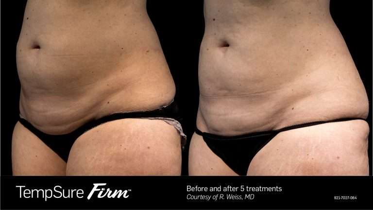 TempSure Firm before-and-after side views of the abdomen
