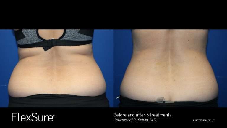 FlexSure before-and-after comparison of the lower back