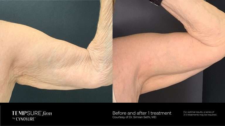 TempSure Firm before-and-after comparison of the upper arm