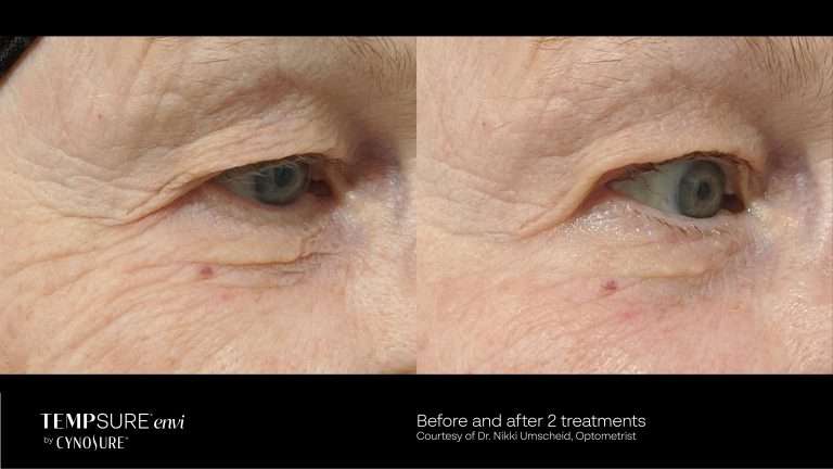 TempSure Envi before-and-after close-up comparison of the skin around an eye