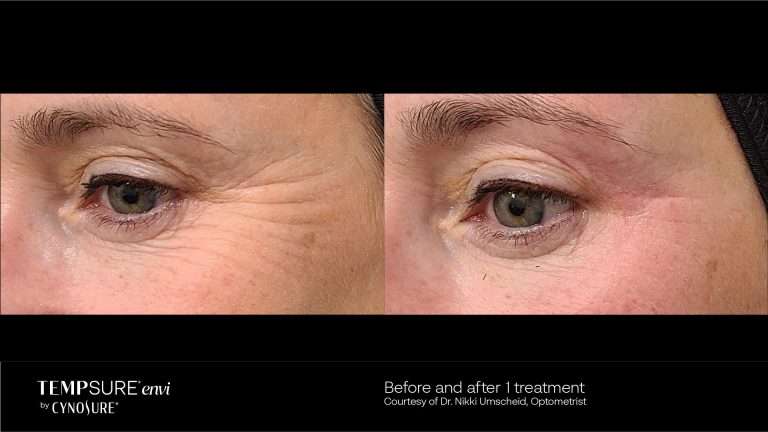 TempSure Envi before-and-after comparison of the outer eye area