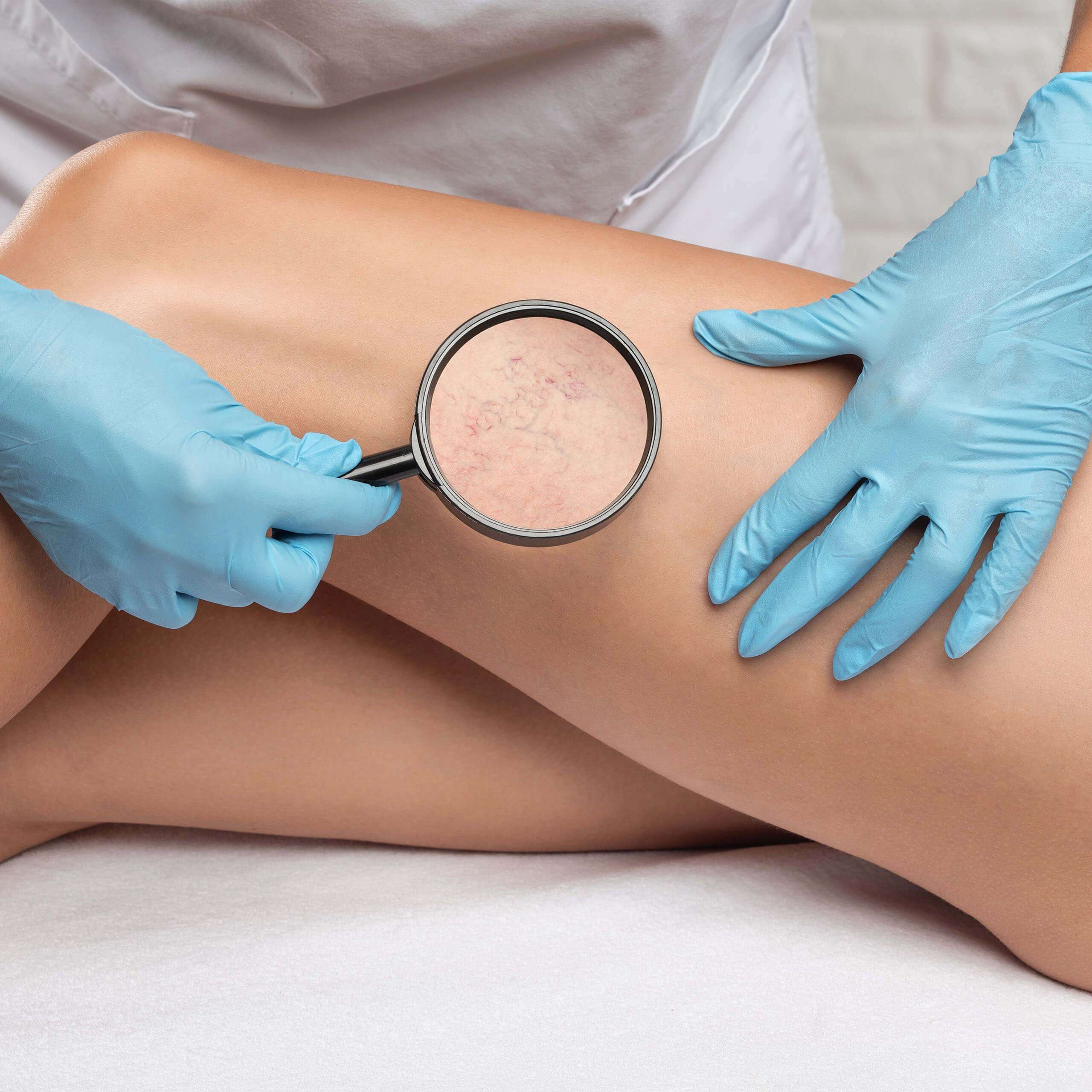 Vascular lesion treatment information